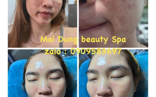 Tái tạo da trẻ hóa – Giải pháp căng bóng, phục hồi da hư tổn tại Mai Dung Beauty Spa