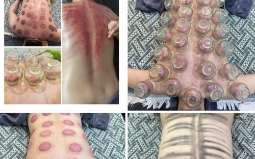 Giải pháp trị liệu vai gáy – bấm huyệt – giác hơi bài hàn tại Mai Dung Beauty Spa