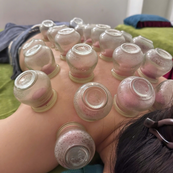 ✨ GIÁC HƠI – PHƯƠNG PHÁP ĐÔNG Y GIÚP CƠ THỂ NHẸ NHÀNG, KHỎE MẠNH ✨