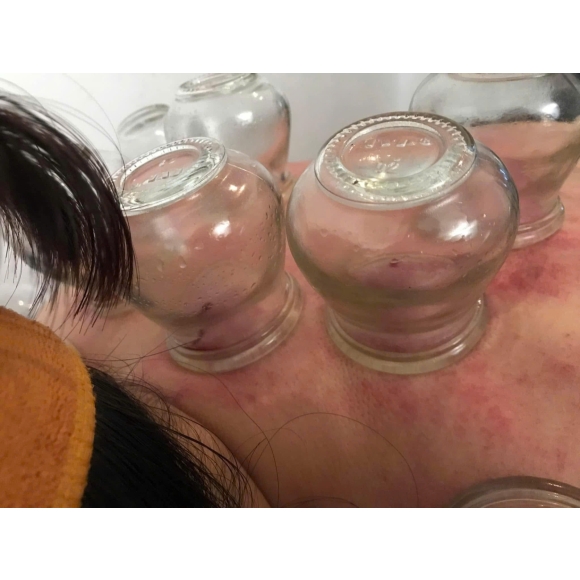 ✨ GIÁC HƠI – PHƯƠNG PHÁP ĐÔNG Y GIÚP CƠ THỂ NHẸ NHÀNG, KHỎE MẠNH ✨