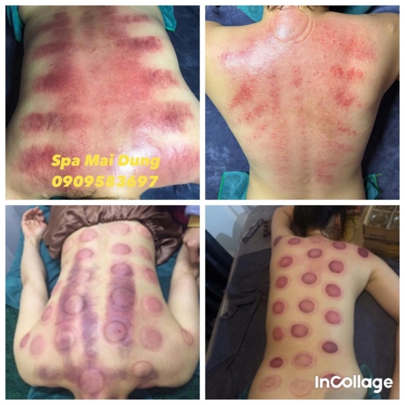 Trị liệu cổ vai gáy, Xoa bóp bấm huyệt, Giác hơi bài hàn, Gội đầu dưỡng sinh, Siết eo giảm béo Trung Hoa