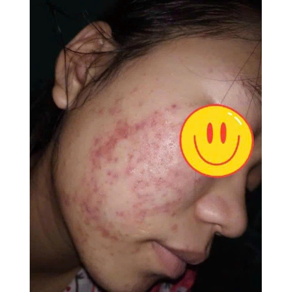 3 Nguyên Tắc Trị Mụn Bạn ' Bắt Chước ' Phải Nhớ