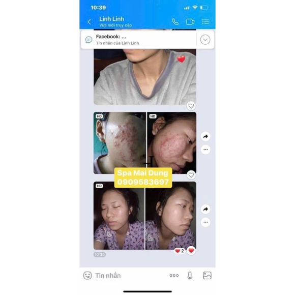 3 Nguyên Tắc Trị Mụn Bạn ' Bắt Chước ' Phải Nhớ