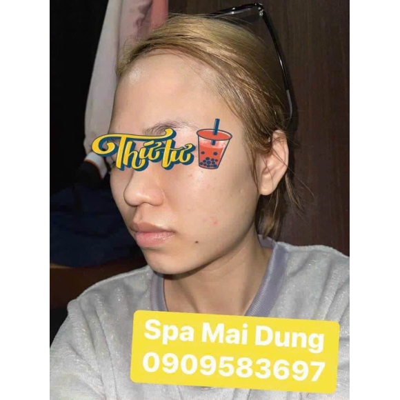 3 Nguyên Tắc Trị Mụn Bạn ' Bắt Chước ' Phải Nhớ